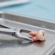 Extractions