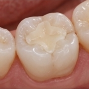 Fillings & Sealants